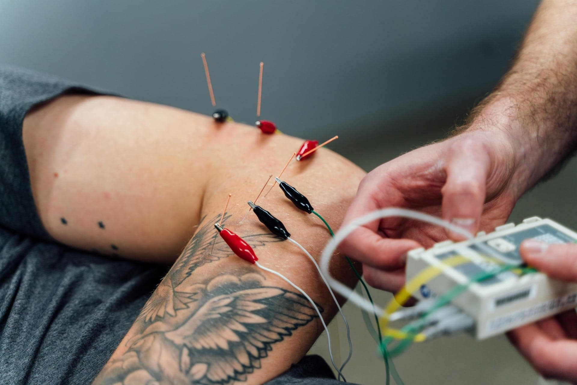 Acupuncture Acupuncture: The